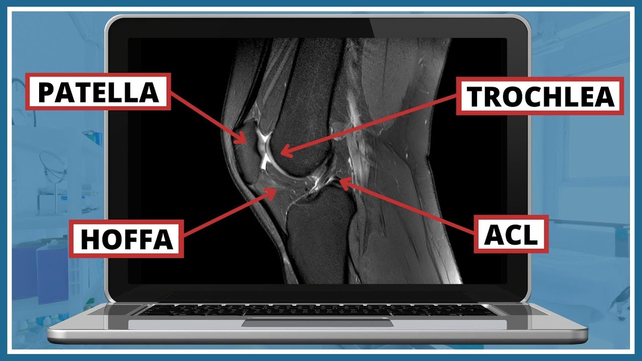 How to Read Knee MRI in Simple Way| Easy Notes and Video