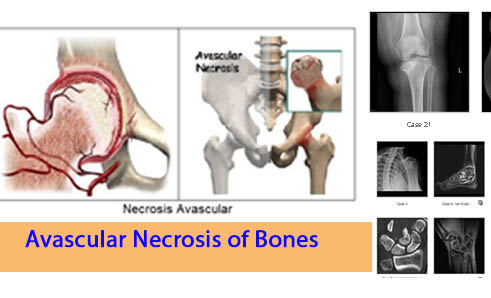 Avascular Necrosis of Bones Ortho Study Notes