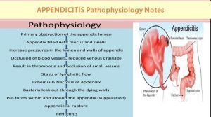 APPENDICITIS Pathophysiology