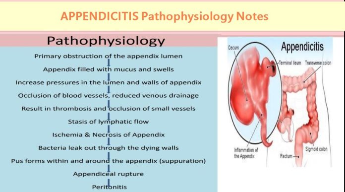 APPENDICITIS Pathophysiology