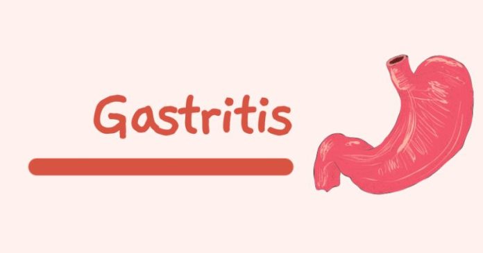 GASTRITIS Pathophysiology Nursing Notes