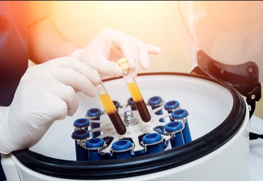 Sterile clinical centrifuge and separated amber platelet buffy coat in high-detail orthopedic lab